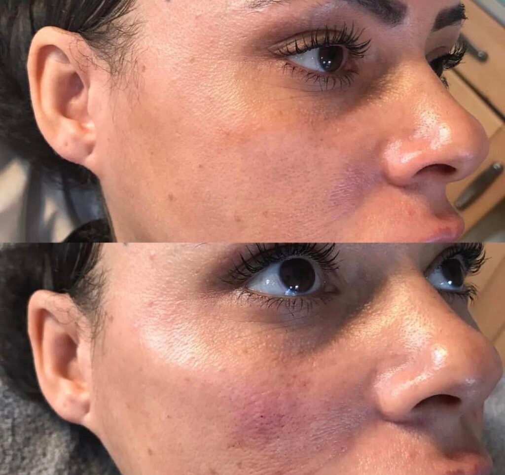 Cheek Filler