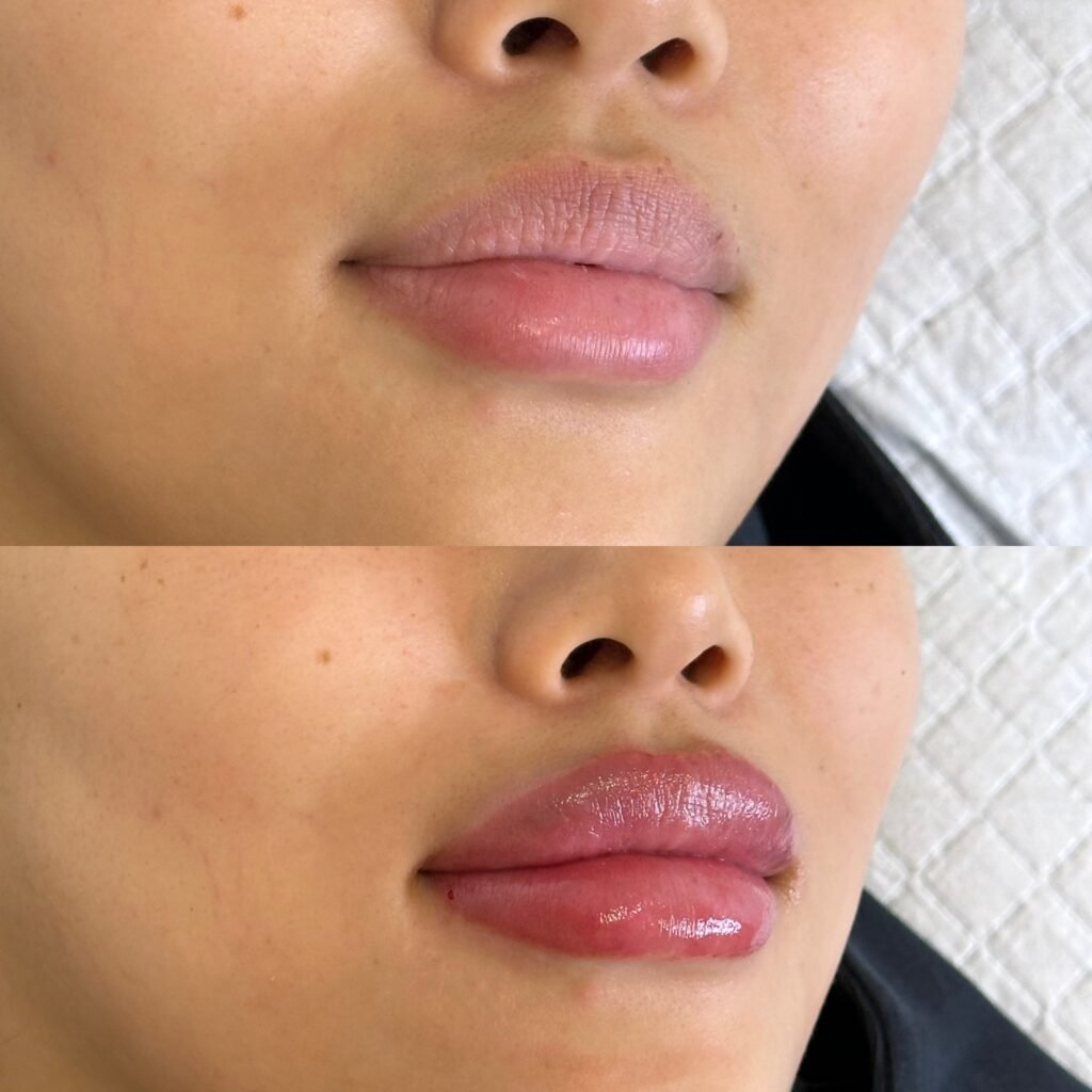 Lip-filler