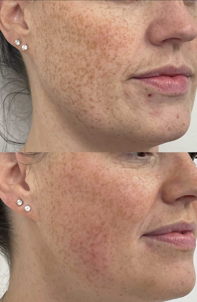 Skin-booster